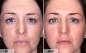 Кротоновый пилинг – новая мода или инновация в косметологии?