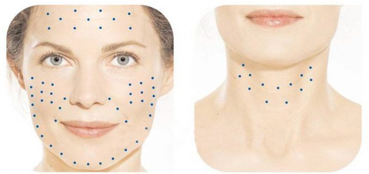 места инъекций для увлажнения