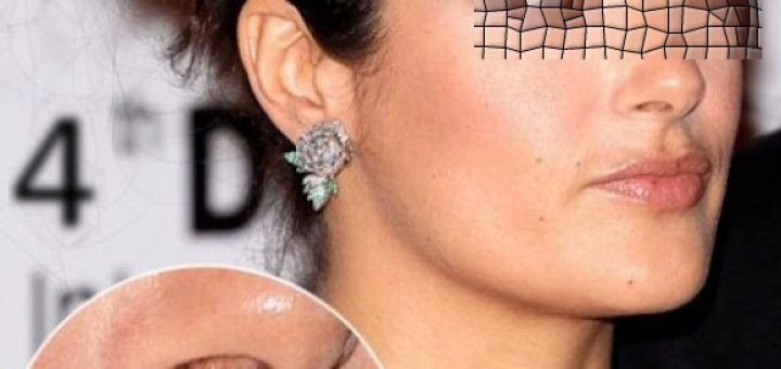 лазерная эпиляция