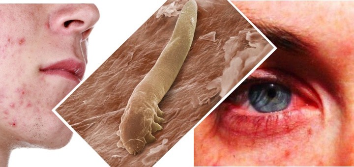 подкожный клещ