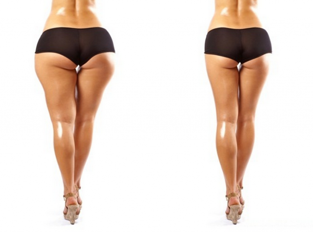 подкожный жир