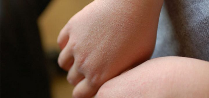 Очень сухая кожа тела: что делать?