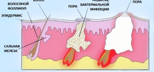 созревание фурункула