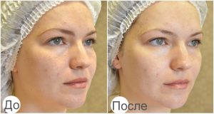 до и после карбокси