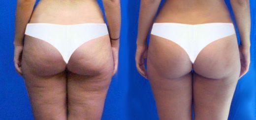 похудеть без целлюлита