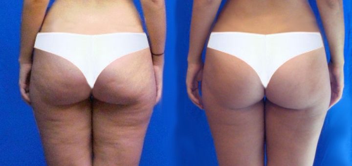 похудеть без целлюлита