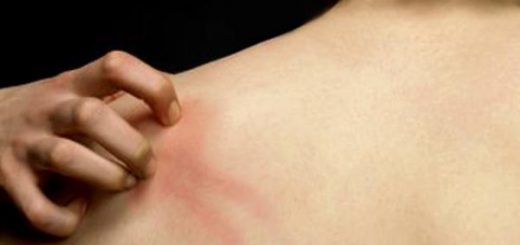 потница у взрослых