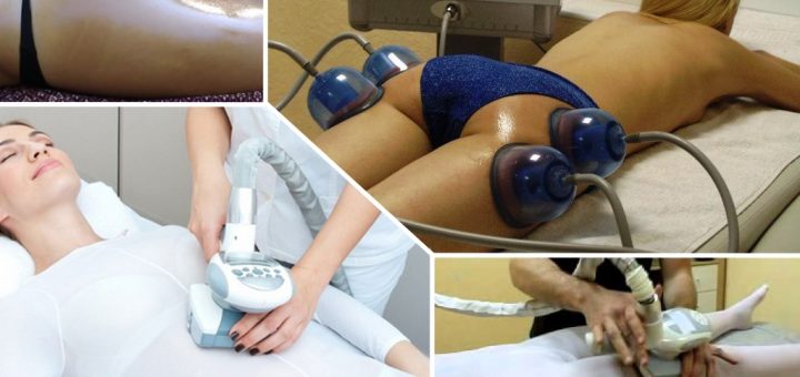 LPG или баночный массаж против целлюлита