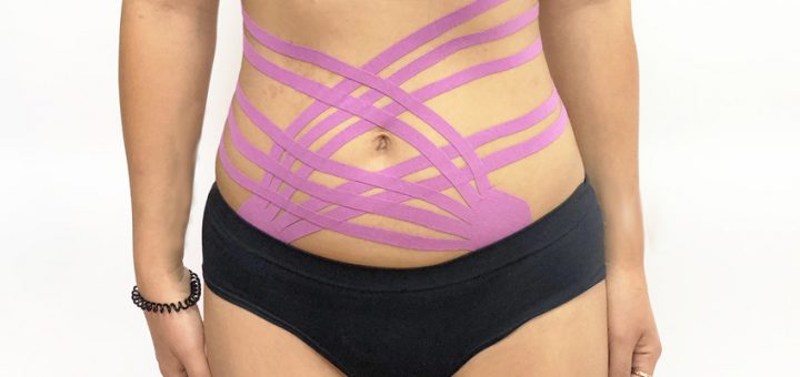 тейпирование живота