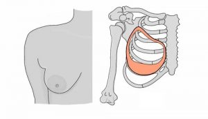Тубулярная грудь 2 типа