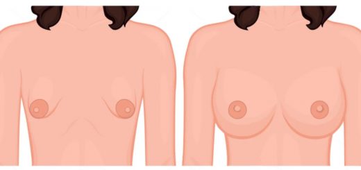 Тубулярная грудь