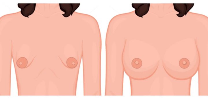 Тубулярная грудь