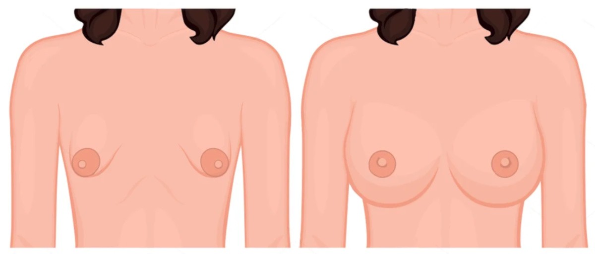 Тубулярная грудь