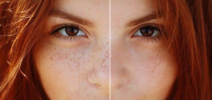 удаляем веснушки домашними средствами