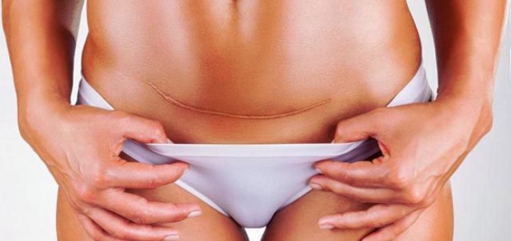 послеоперационный шрам после абдоминопластики