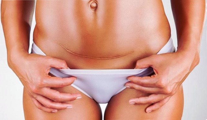 послеоперационный шрам после абдоминопластики