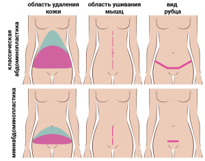 сравнение миниабдоминопластики и абдоминопластики