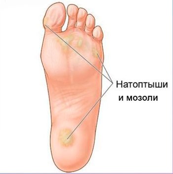 Натоптыши и мозоли
