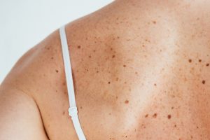 пигментные пятна на теле