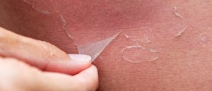 слезает кожа после загара