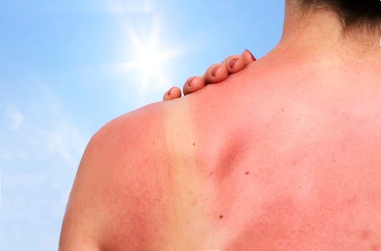 обгорела на солнце